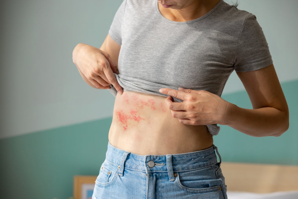 Thymosin Alpha 1: A Powerful Peptide for the Treatment of Shingles