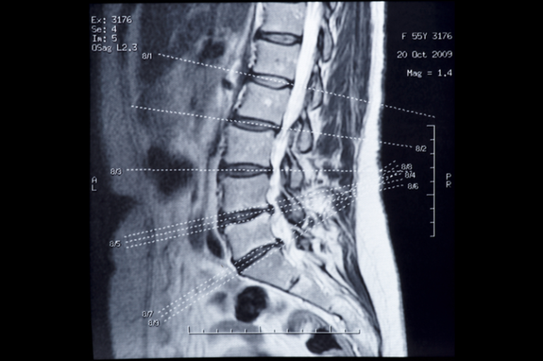 MRI For Musculoskeletal Pain Is Often Not Helpful