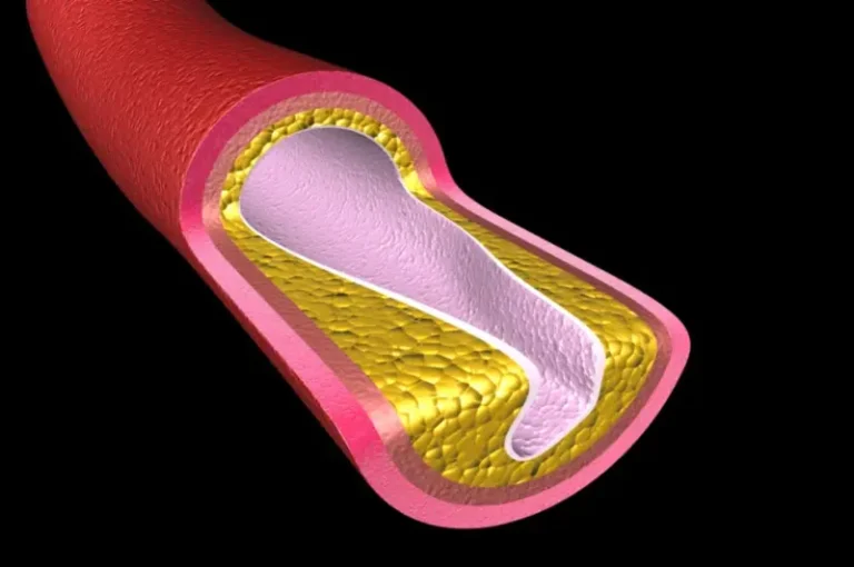 CIMT Testing Predicts MI & Strokes