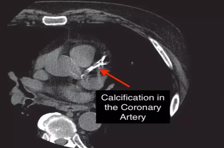 Coronary Artery Calcium Score (CAC)