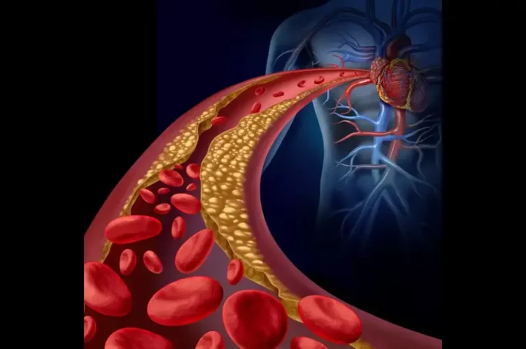 Lipoprotein-Associated Phospholipase A2 (Lp-PLA2)