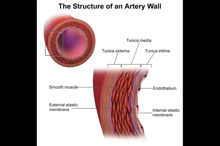 Arterial Remodeling With Hypertension