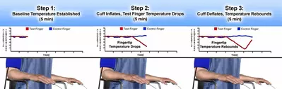 Endothelial dysfunction measured by endothelix