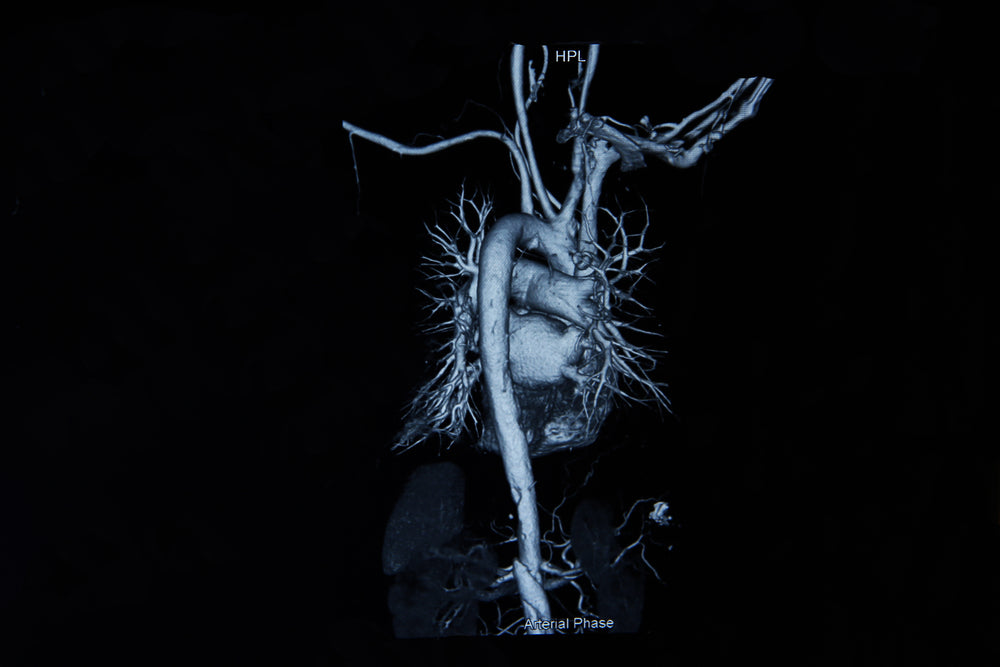 Do You Have Plaque in Your Arteries? CT Angiogram with Cleerly Will Le ...