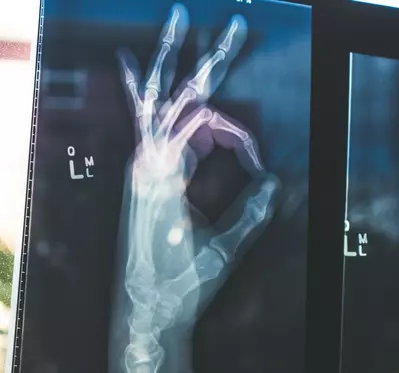 x-ray of a hand