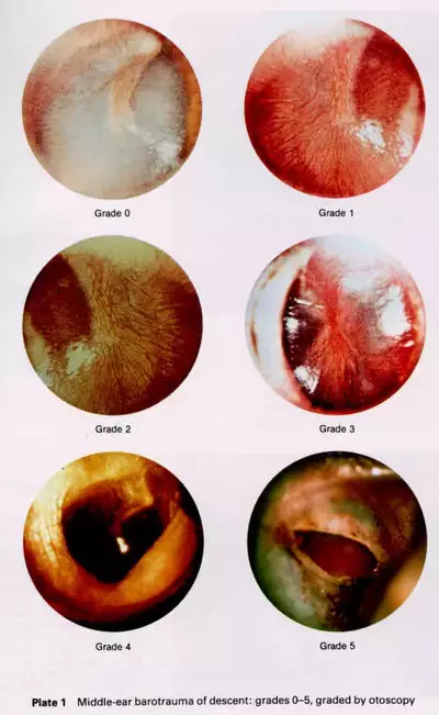 Teed Ear Barotrauma Classification Diving Injury Diver