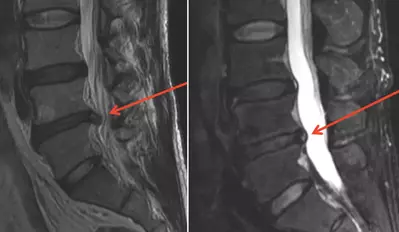 low back herniated disk before and after prolotherapy cure