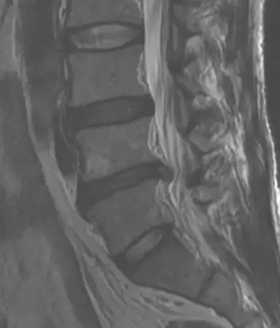 low back disk herniation before prolotherapy